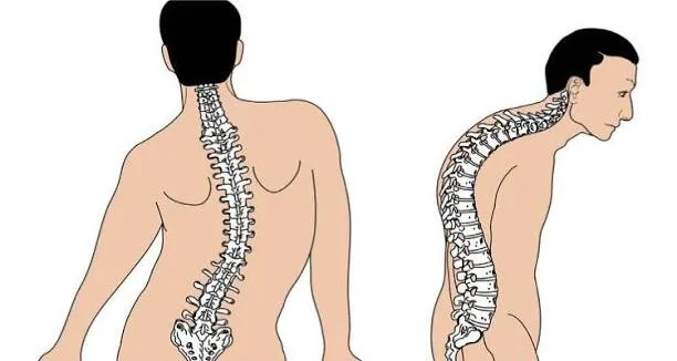 Spinal Deformities image 1
