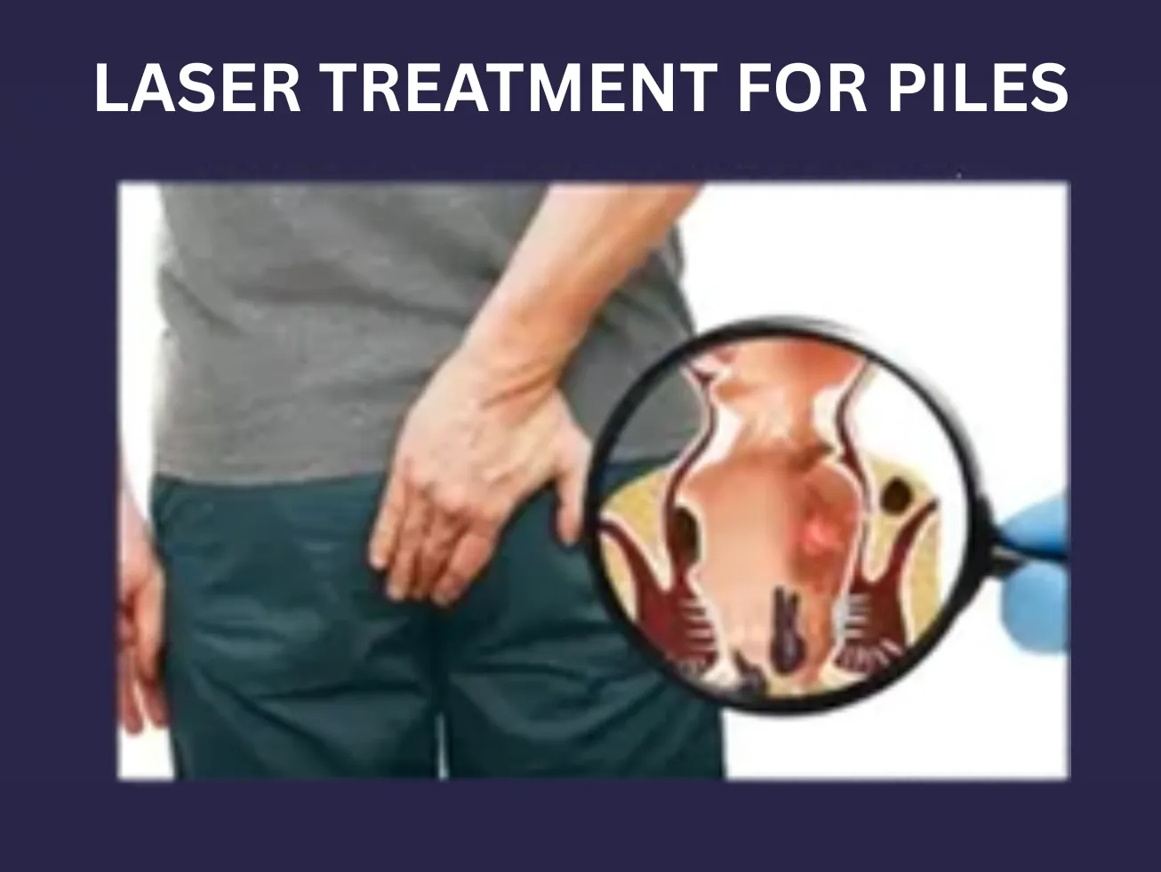 LASER TREATMENT FOR PILES image 1