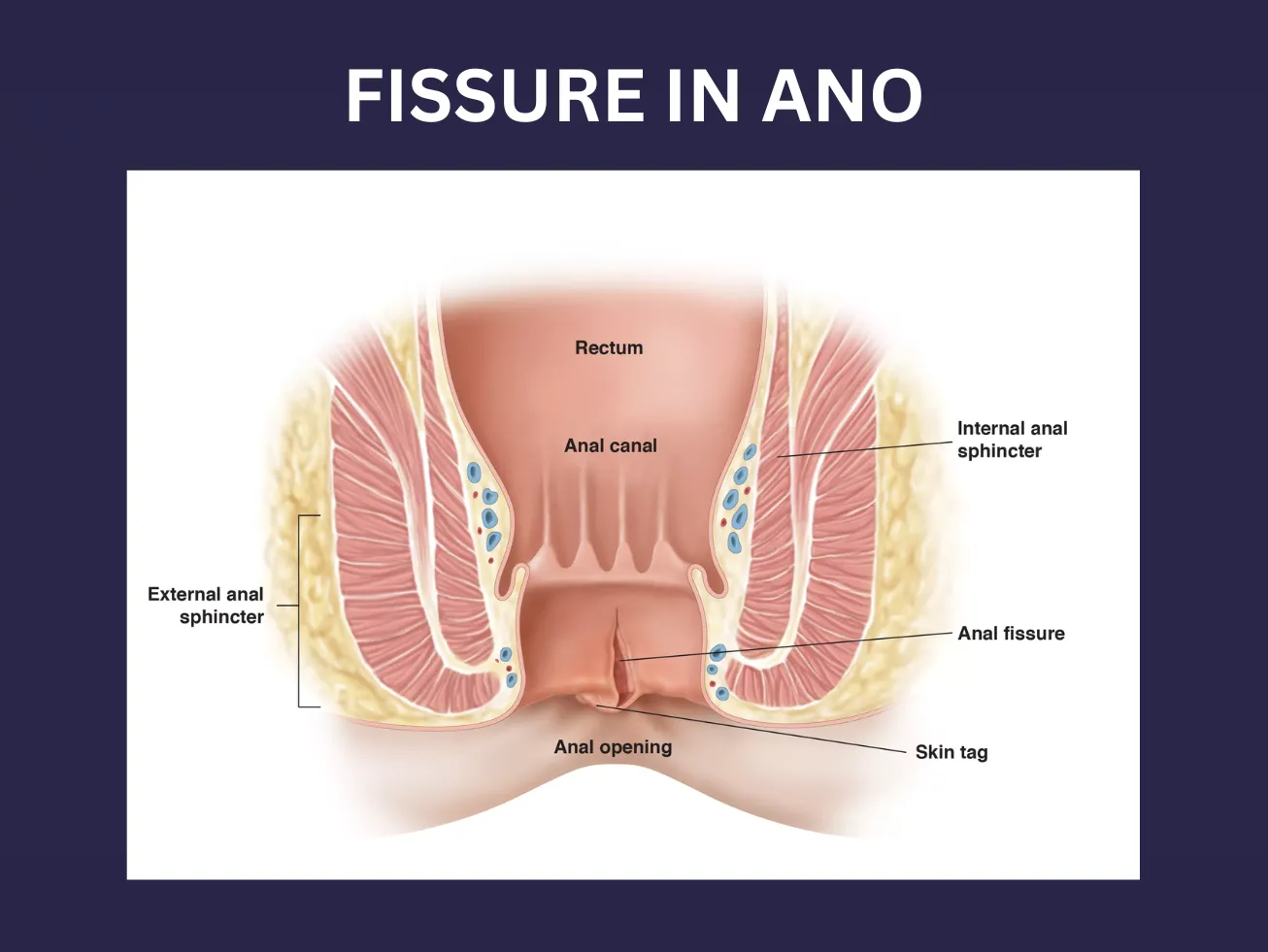 FISSURE IN ANO image 1