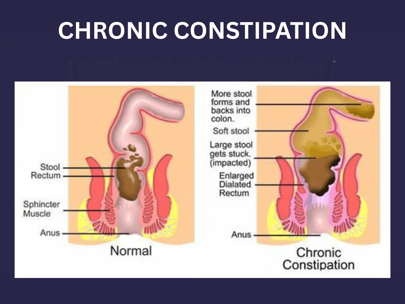 CHRONIC CONSTIPATION image 1