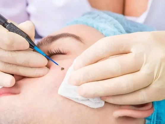 MOLE REMOVAL | SKIN TAG REMOVAL | WART REMOVAL image 1