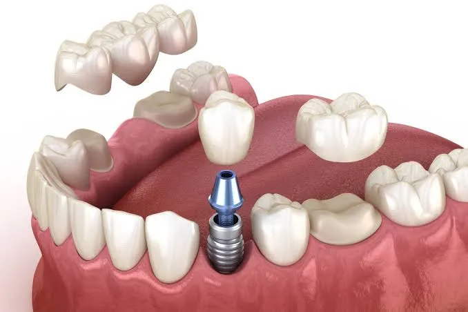 Dental Crowns & Bridges image 1