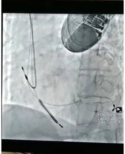 Cardiac Resynchronisation Therapy (CRTD) service image