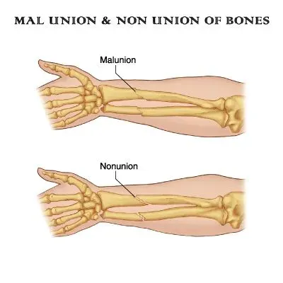 Nonunion Malunion Treatment service image