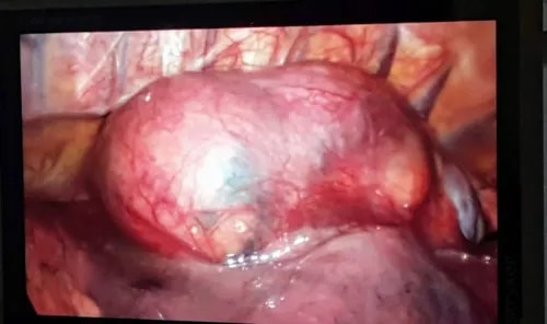 Thoracoscopic Mediastinal Node Biopsy product image