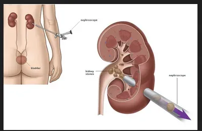 PCNL service image