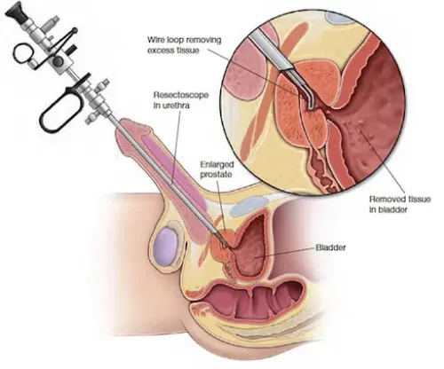 TURP for Enlarged Prostate service image
