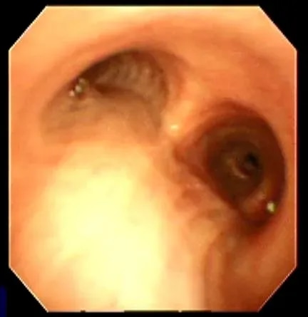 Bronchoscopy product image