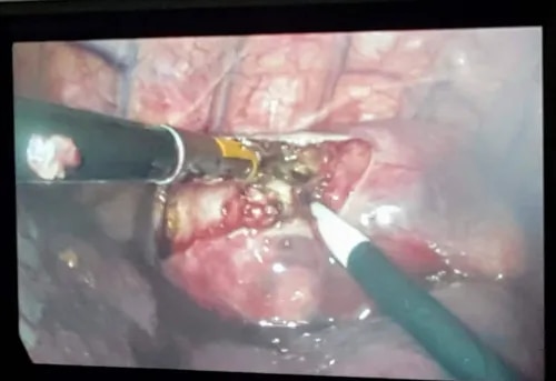 Thoracoscopy product image