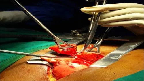 Wedge Resection product image