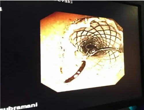 Airway Stenting product image