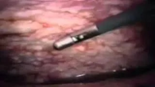 Thoracoscopic Pleurodesis product image