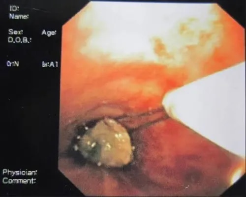 Endobronchial Polypectomy product image