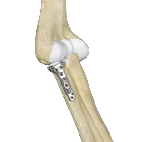 Orthopedic Surgery for Fractures  service image