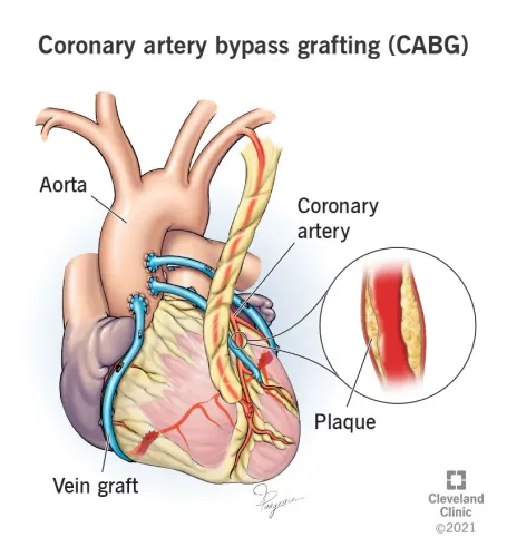 Coronary Bypass Surgery service image