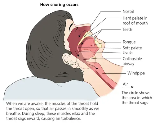 Snoring service image