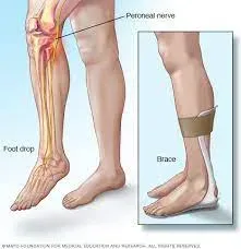 Foot Drop service image