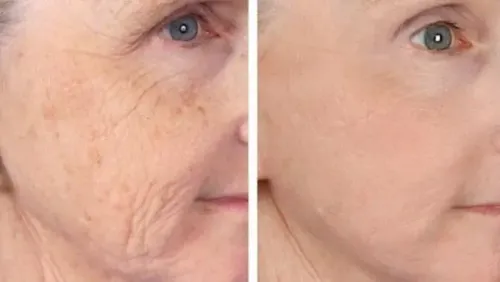 LASER ANTI AGEING TREATMENT service image
