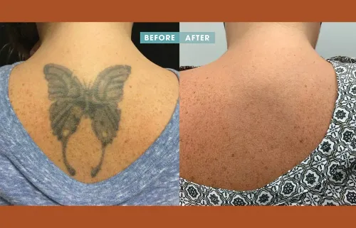 TATTOO REMOVAL service image