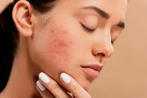 ACNE TREATMENT service image