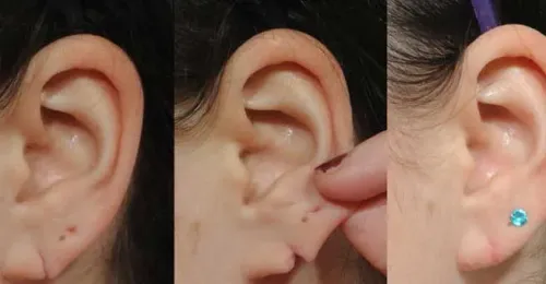 EAR LOBE REPAIR | LOBULOPLASTY service image