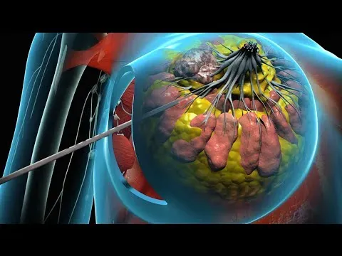 CANCER SURGERY  service image