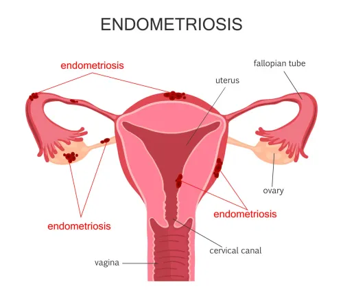 Laparoscopic Management of Endometriosis Specialist in Andheri West,Mumbai service image