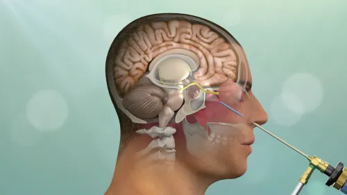 Endonasal Surgery for Tumors service image