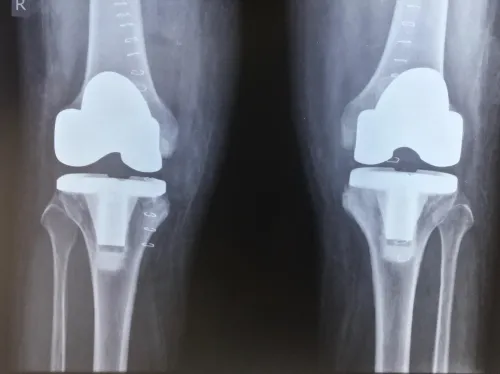 Total Knee Replacement service image