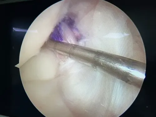Arthroscopy and Sports injury(ACL/MENISCUS/ROTATOR CUFF INJURY) service image