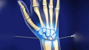Hand/Wrist Arthroscopy service image