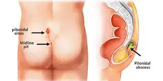 PILONIDAL SINUS service image