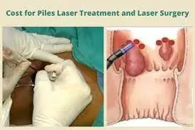 LASER TREATMENT FOR PILES, FISSURE, FISTULA etc. service image