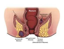 FISTULA service image