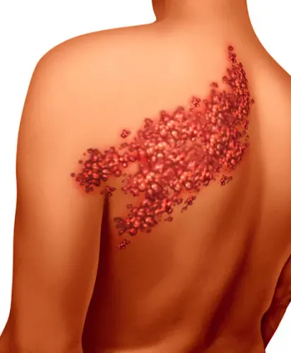 Postherpetic Neuralgia Treatment Clinic in Pune service image