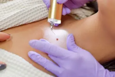 Laser Treatment For Birthmarks service image