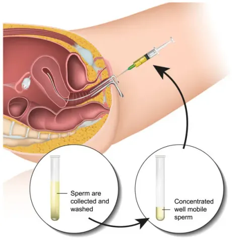 IUI Treatment service image