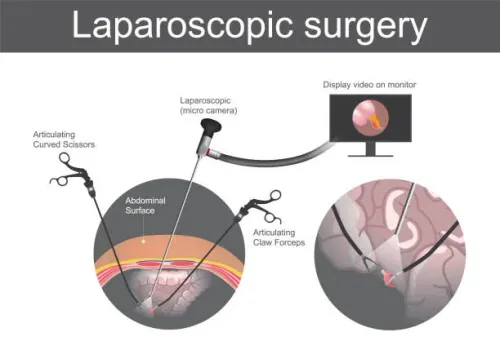 Laparoscopy Treatment service image