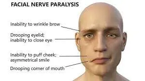 Facial Nerve Disorders service image