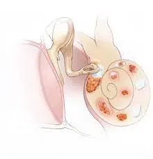 Otosclerosis service image