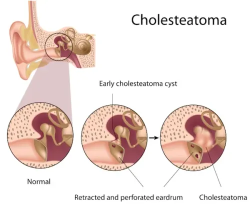 Cholesteatoma service image