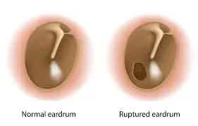 Perforated Ear Drum service image