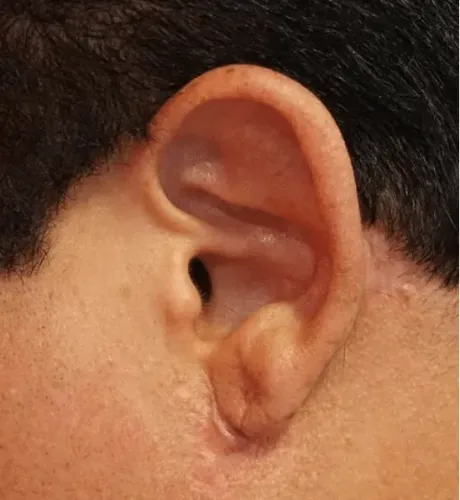 Tumors Of The Ear service image