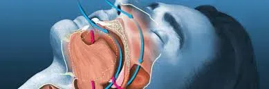 Snoring Evaluation service image