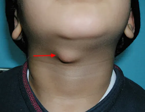 Thyroglossal Cyst service image