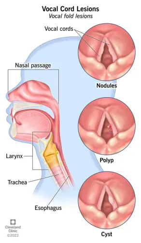 Voice Surgeries Microlaryngeal Surgery For Vocal Cord Swelling service image