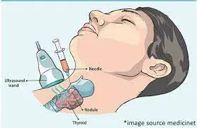 Lymph Nodes Biopsy service image