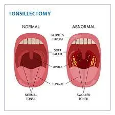 Tonsillectomy service image