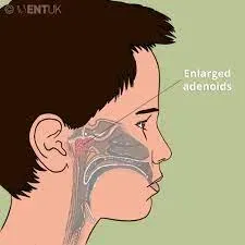 Adenoidectomy service image