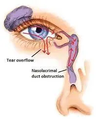 Endoscopic Dacrocystorhinostomy  service image